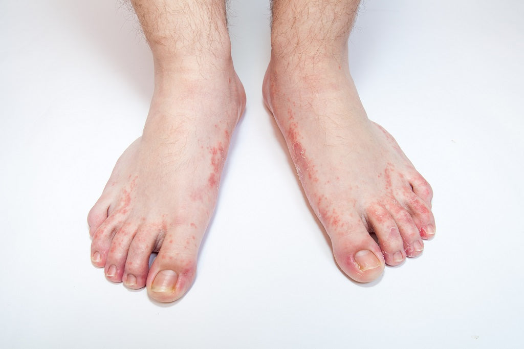 Athlete s Foot Causes Symptoms Remedies