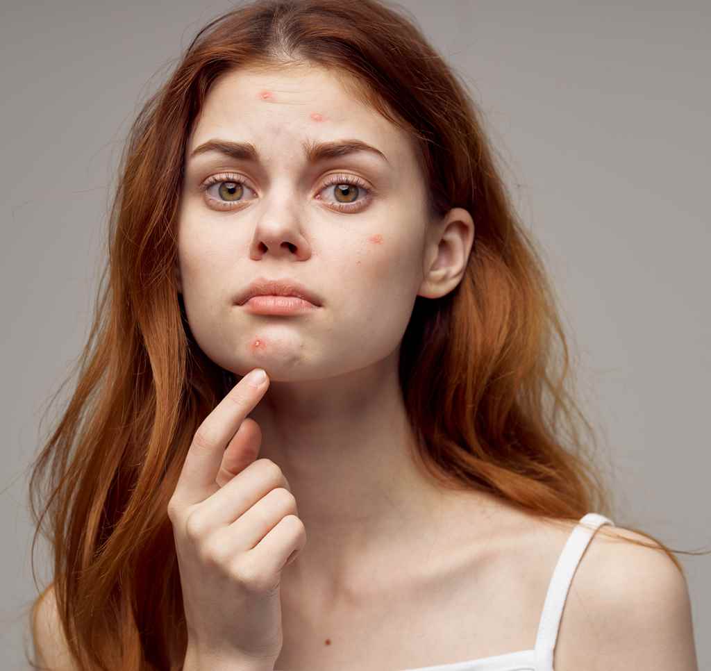 Castor Oil to treat Acne