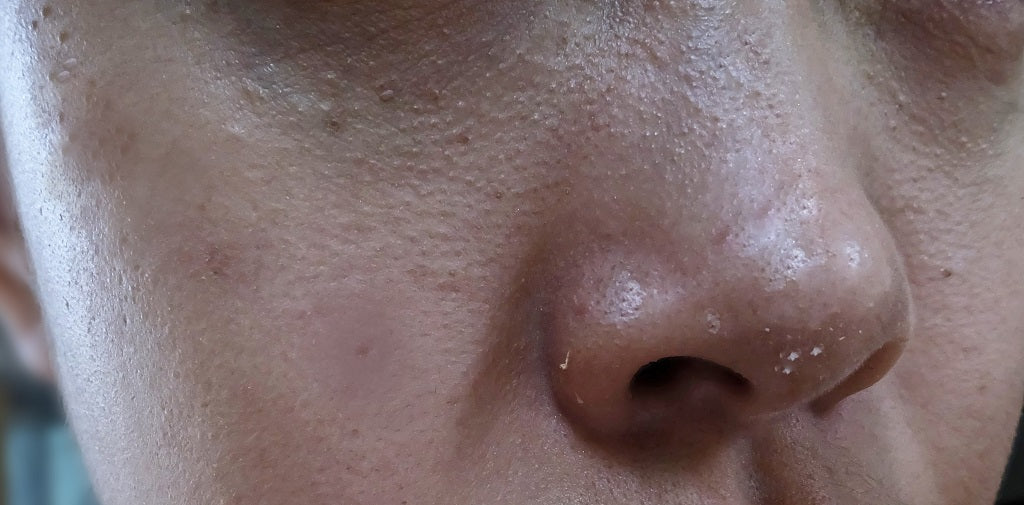 Clogged Pores - Causes, Tips and Natural Remedies