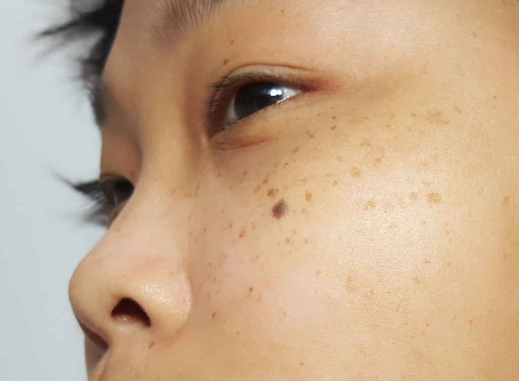 15 Natural Ways to Remove Scars