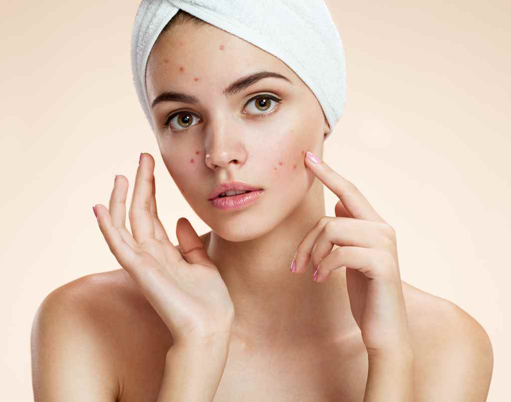 DIY for acne Tea tree oil for acne