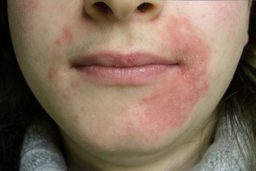Dermatitis---Types,-Causes,-Symptoms-and-Home-Remedies