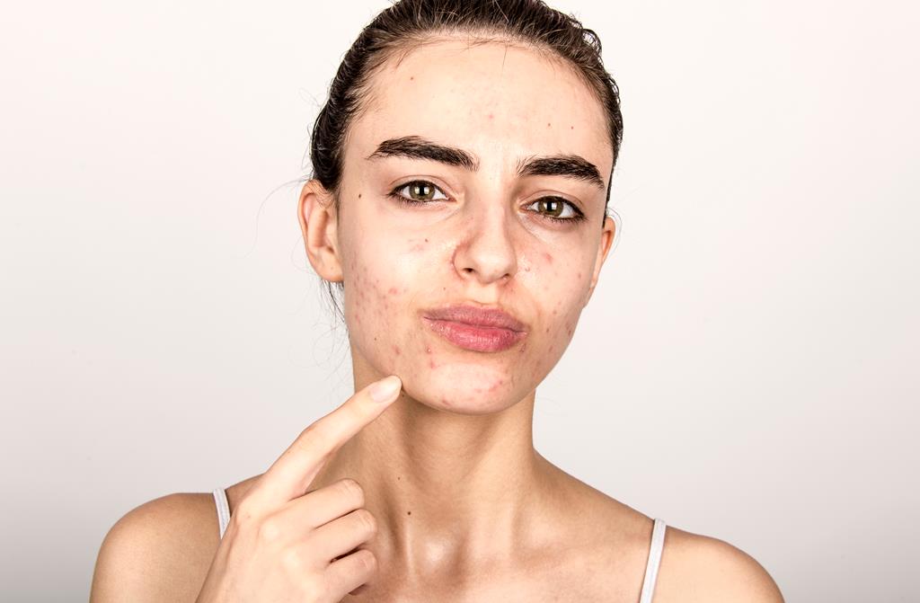 10 Best Essential Oils For Acne Scars