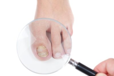 Essential Oils Toenail Fungus