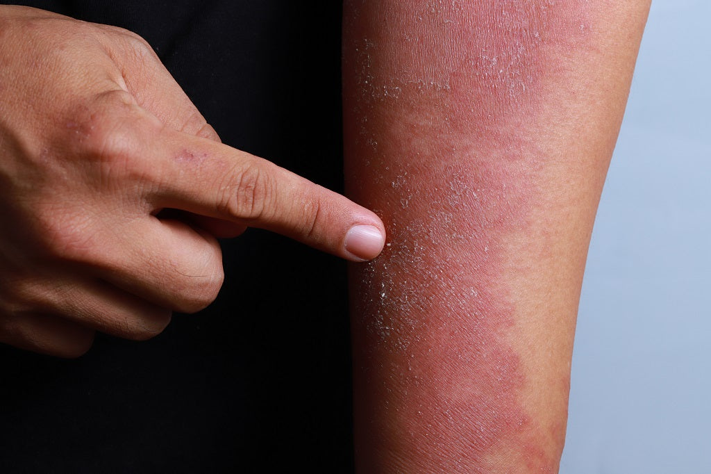 What causes fungal infection top in private parts