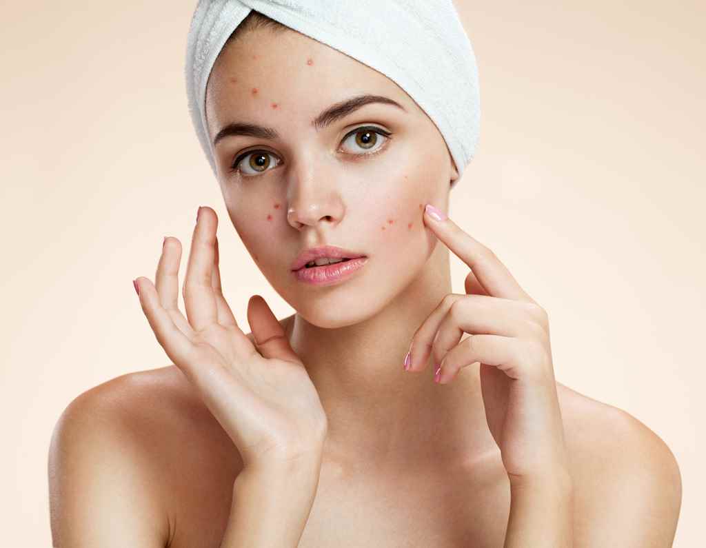 How to use Eucalyptus Oil to treat acne