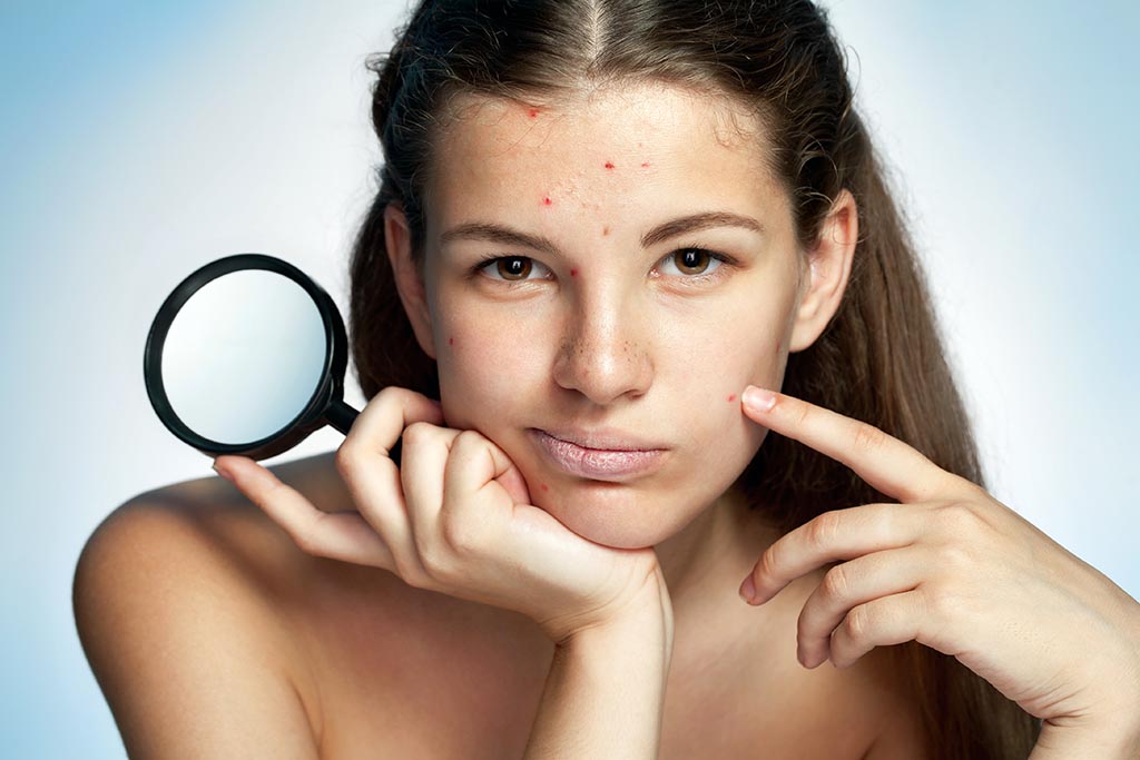 Why to Use Argan Oil for Acne?