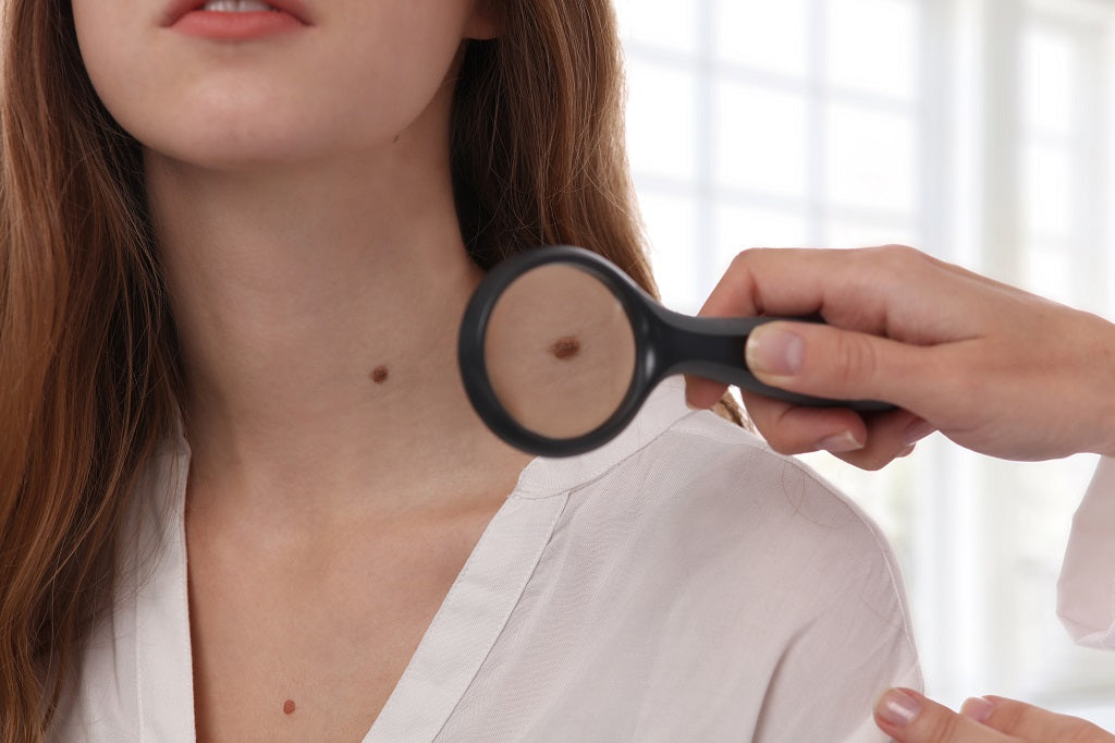 15 Best Home Remedies For Warts