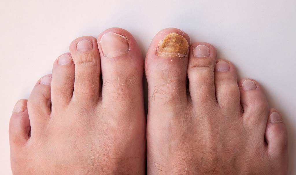 Tea Tree Oil for Nail Fungus - How to Apply and its Effects