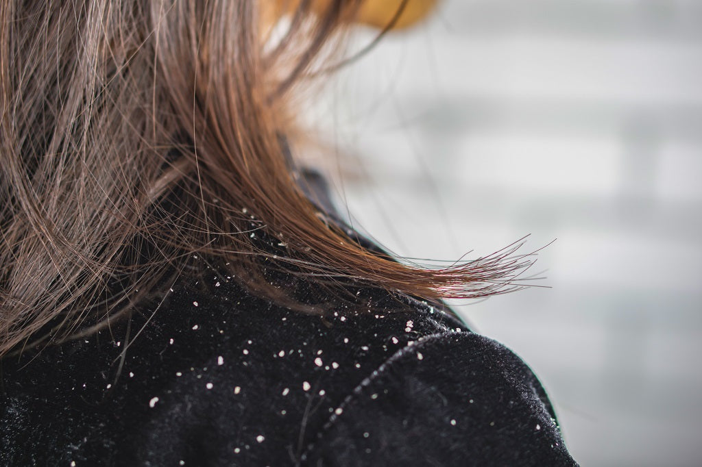 EVERYTHING YOU NEED TO KNOW ABOUT DANDRUFF IS RIGHT HERE