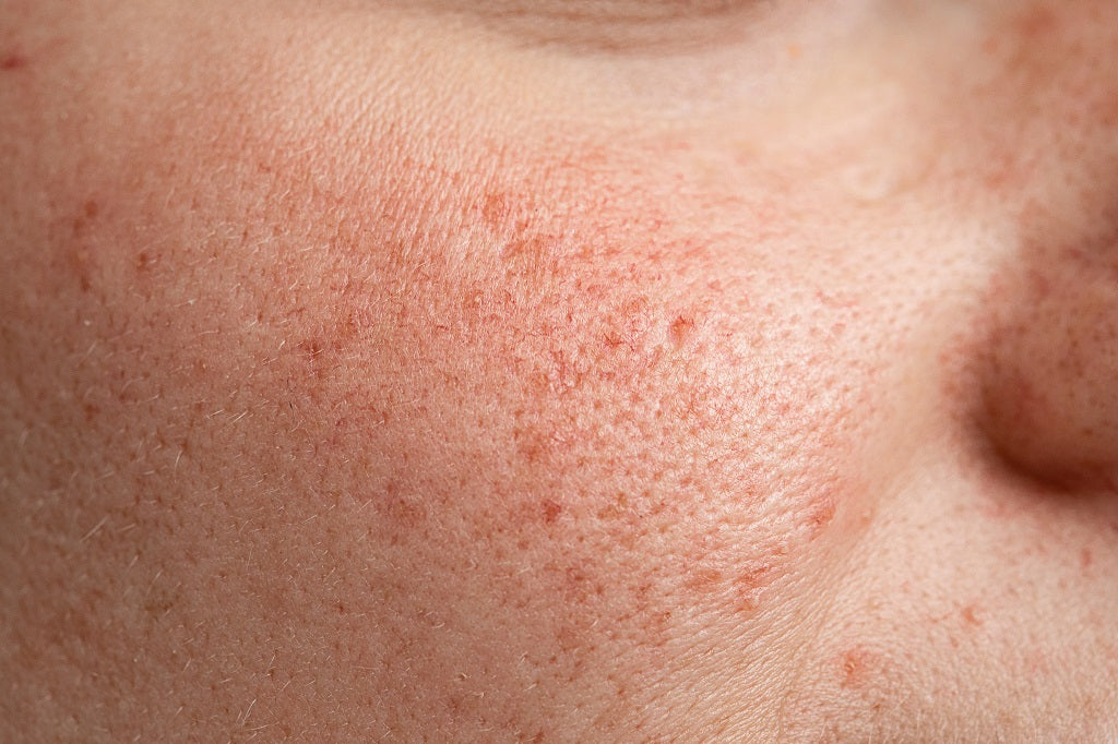 15 Simple Ways to Remove Open Pores from Face