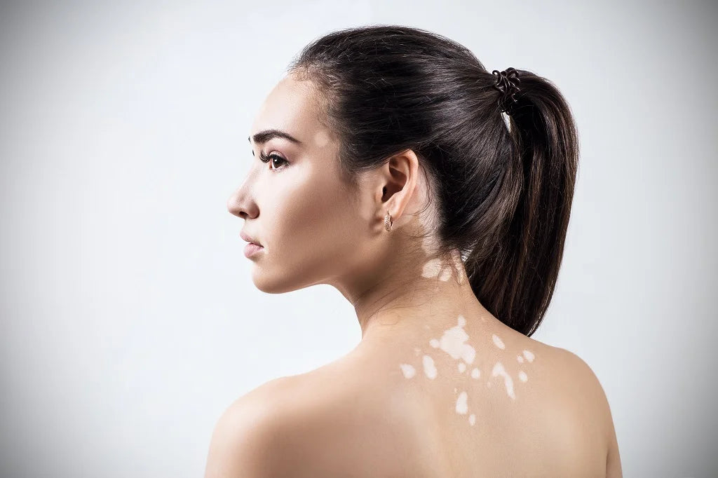 White Spots on Skin - Causes, Symptoms, Home Remedies and Prevention