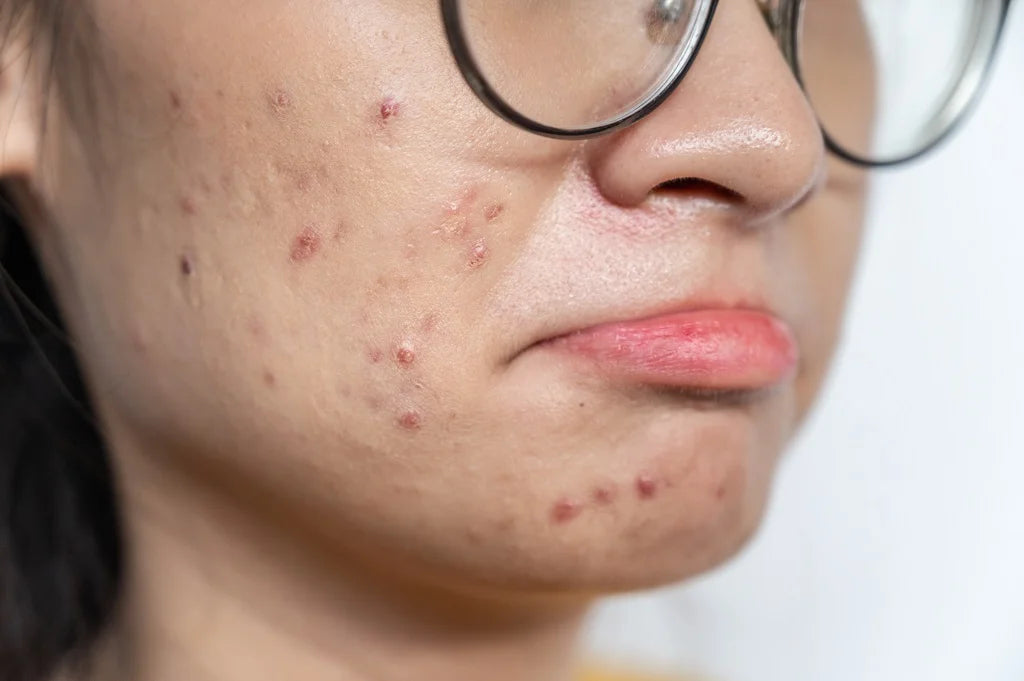 Acne