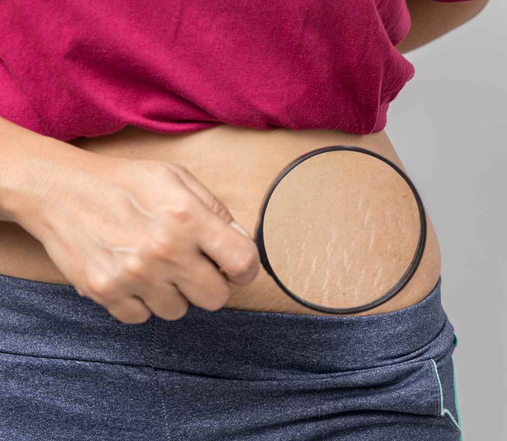 Tips to Use Castor Oil for Stretch Marks