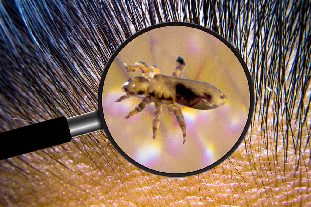 How to Get Rid of Head Lice with Tea Tree Oil?