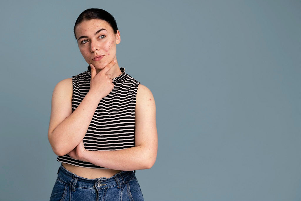 Is your acne hormonal or stress-induced? Let’s find out!