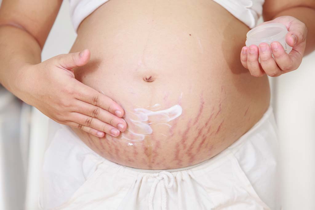 Stretch Marks