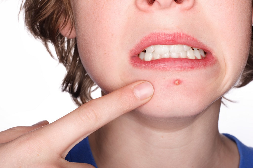 How To Get Rid of Acne 