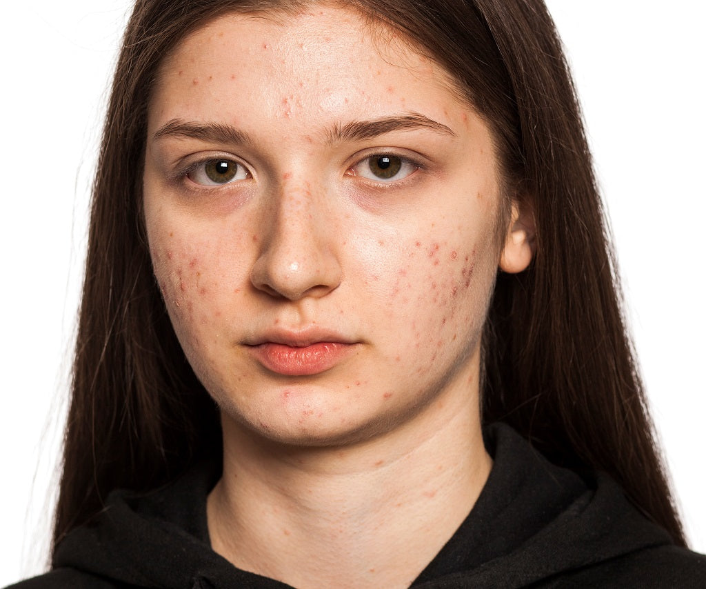 Rosehip Oil- A Safe and Natural Treatment for Acne and Scars