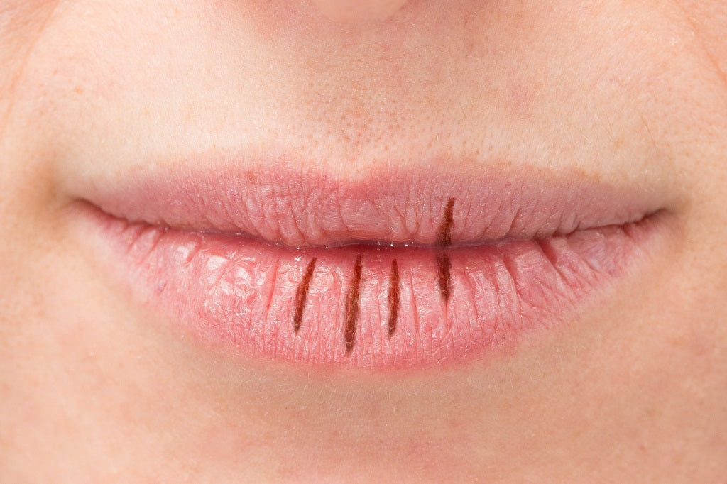 8 Natural Remedies to Get Rid of Cracked Lips