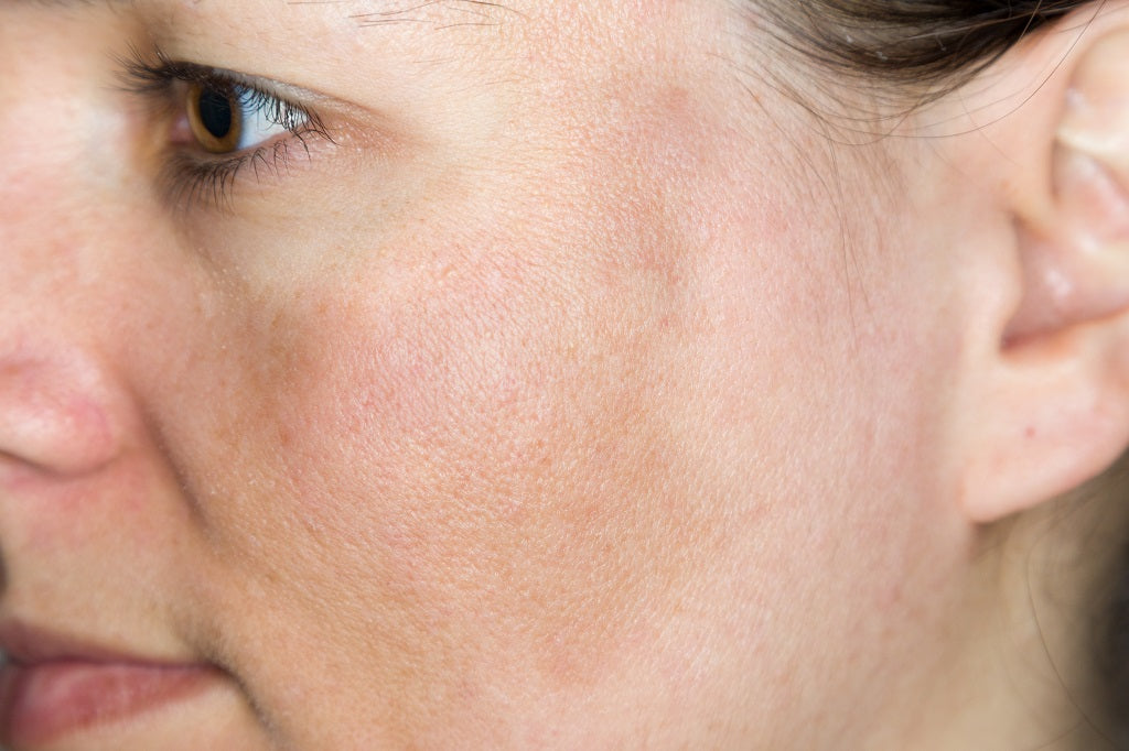 Skin Pigmentation (Hyperpigmentation) - Causes, Home Remedies and Tips