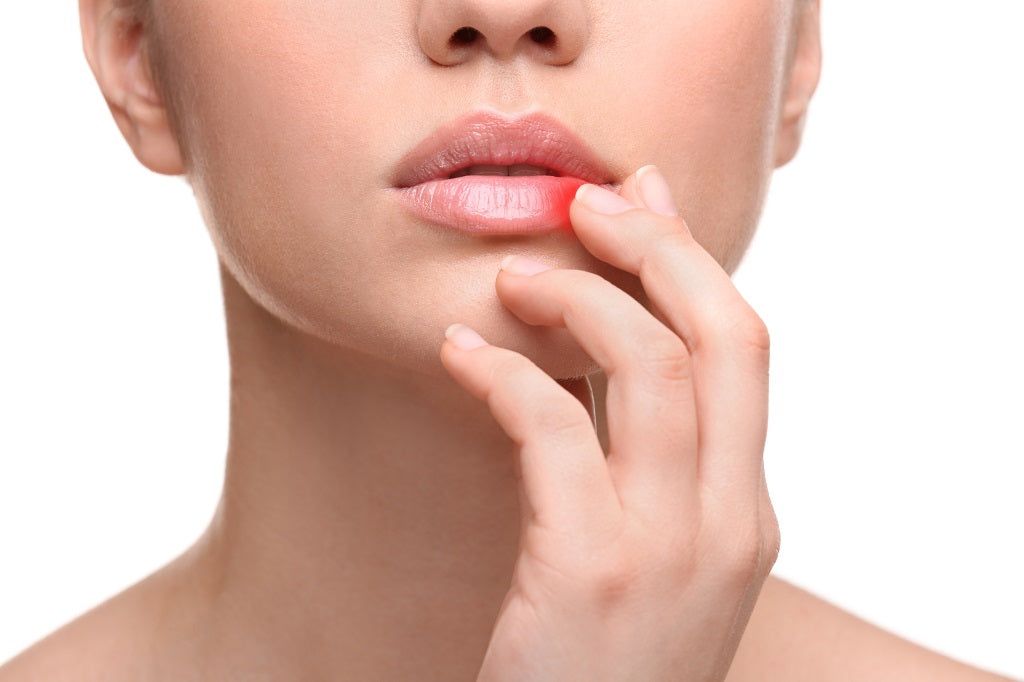 Cold Sore - Signs, Diagnosis And Home Remedies