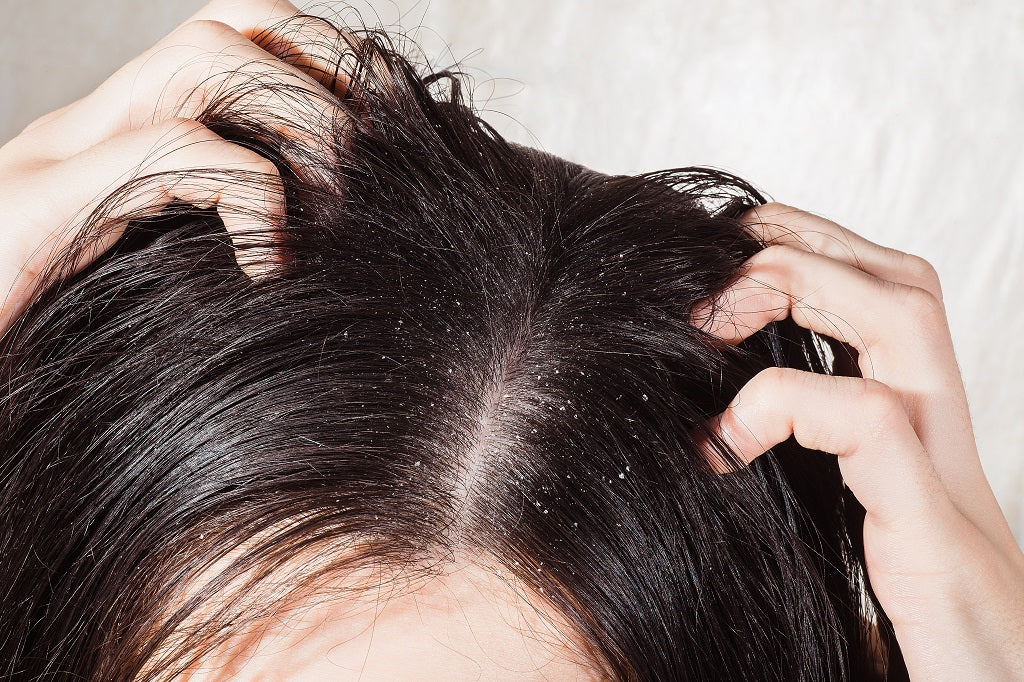 Effective Home Remedies & Tips For Dandruff Control
