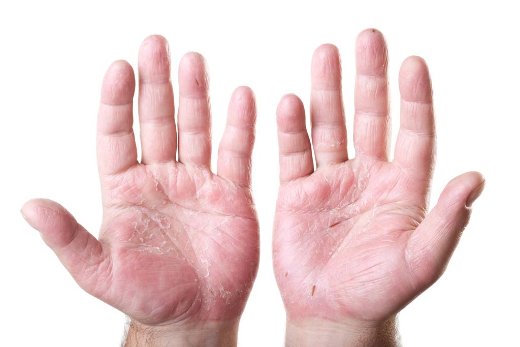 Effective-Tips-to-Get-Rid-of-Skin-Peeling-on-Hands