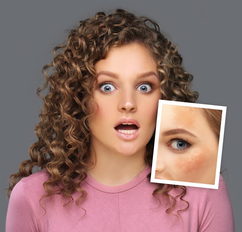 Essential Oils For Pigmentation