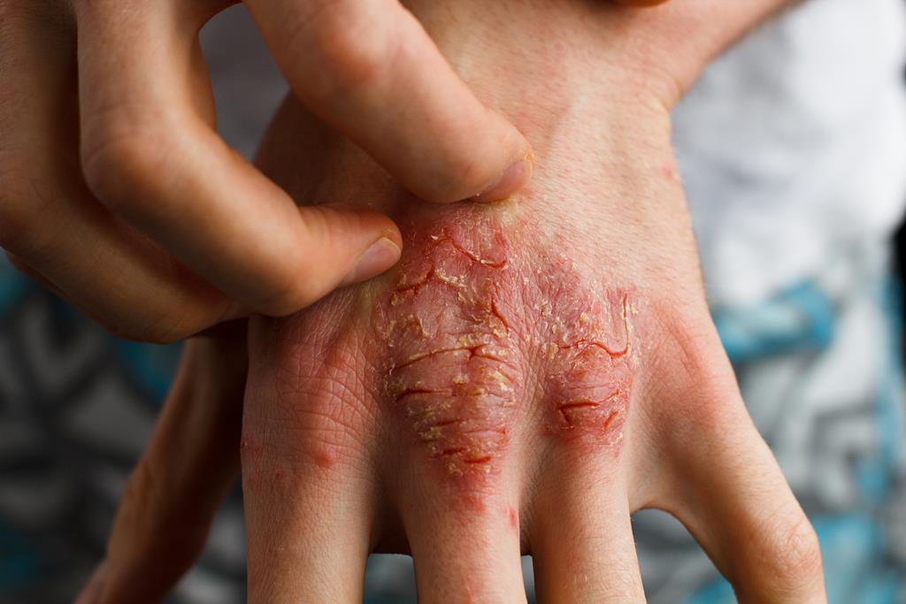 Essential Oils For Psoriasis