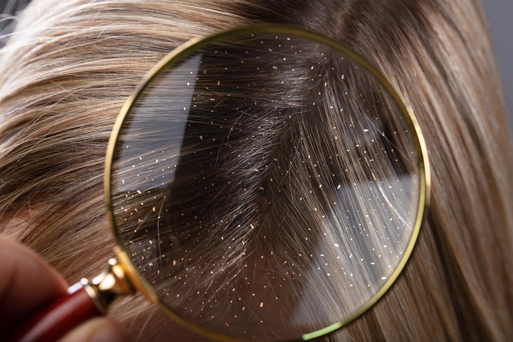 8 Amazing Essential Oils For Dandruff