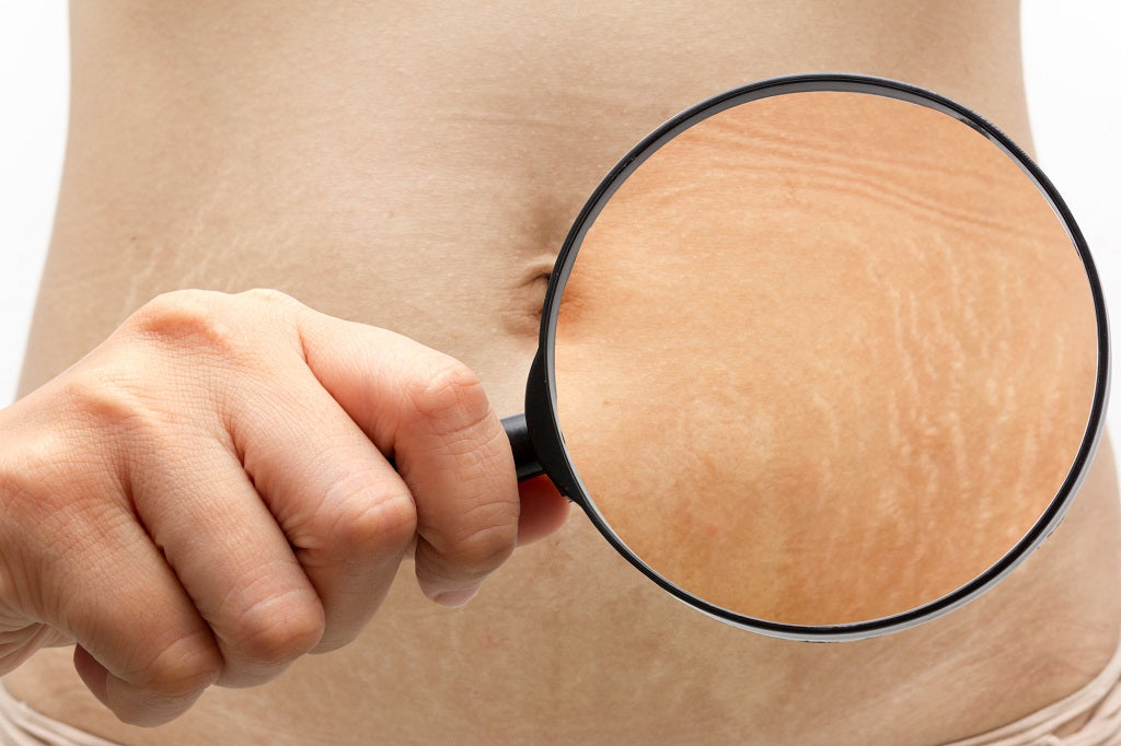 How Following These Simple Practices Can Effectively Help Evade Stretch Marks