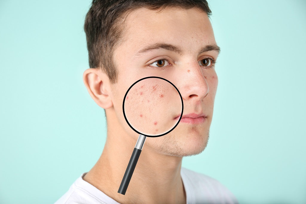 Powerful and Effective Home Remedies For Acne