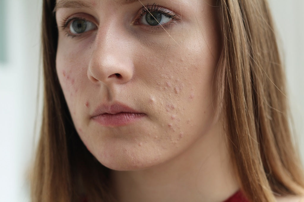 Tips and Home Remedies for Pimples & Acne