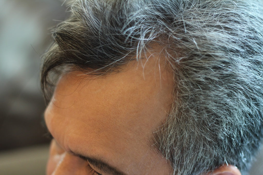 Premature Gray Hair - Causes, Treatment & Prevention