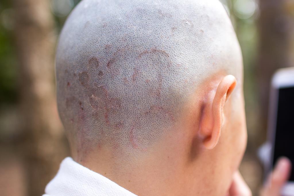 Ringworm - Causes, Symptoms, Home Remedies And Prevention