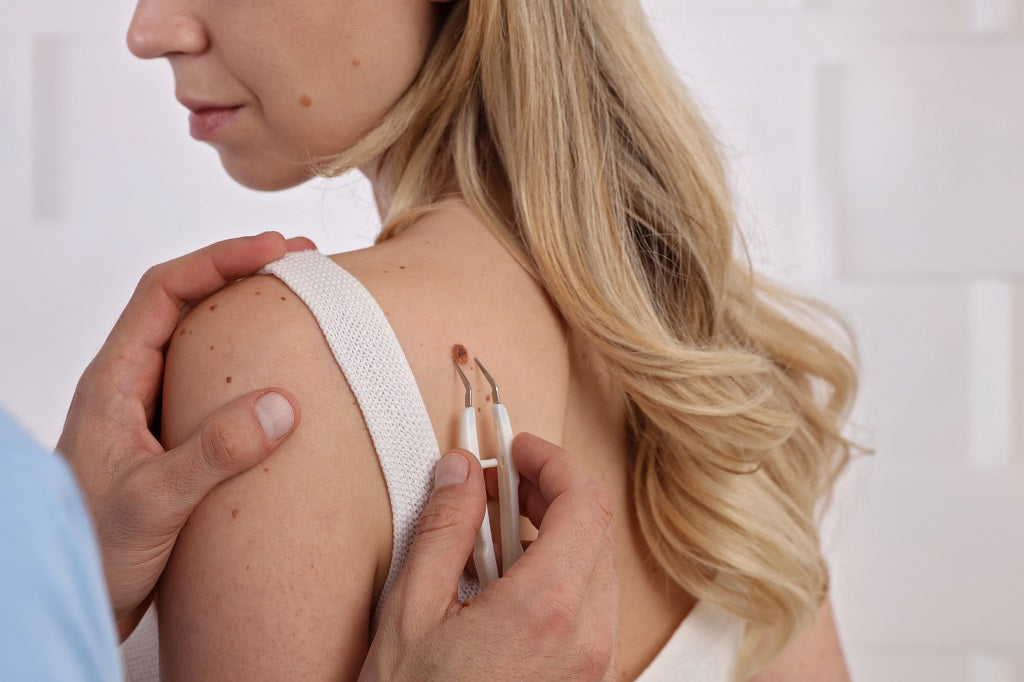 10 Effective Home Remedies for Skin Tags