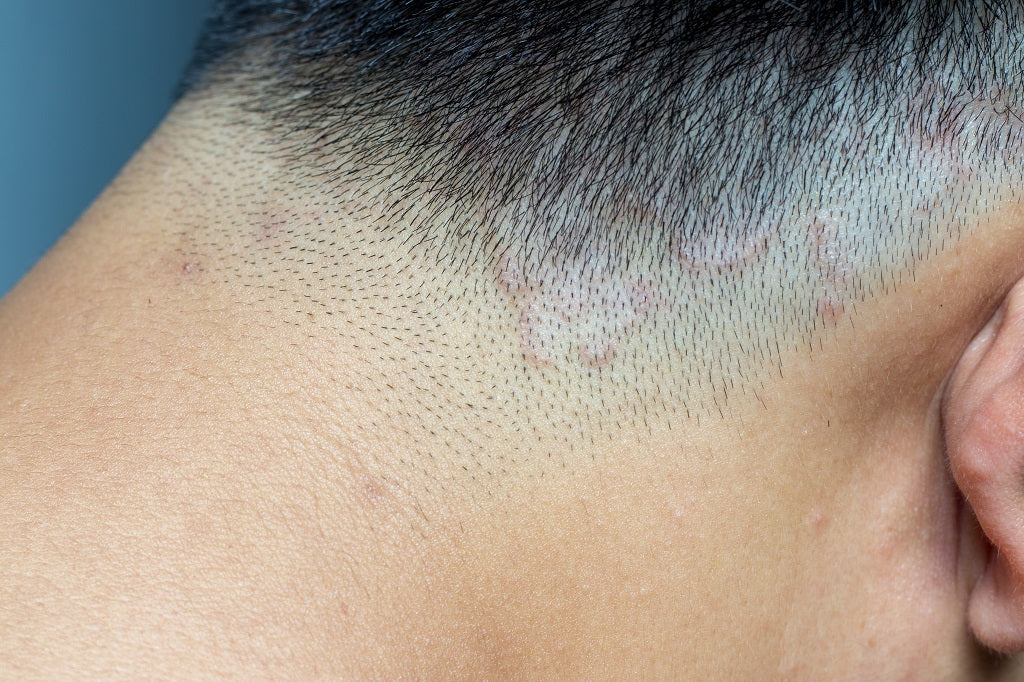 Tinea capitis image from Anveya