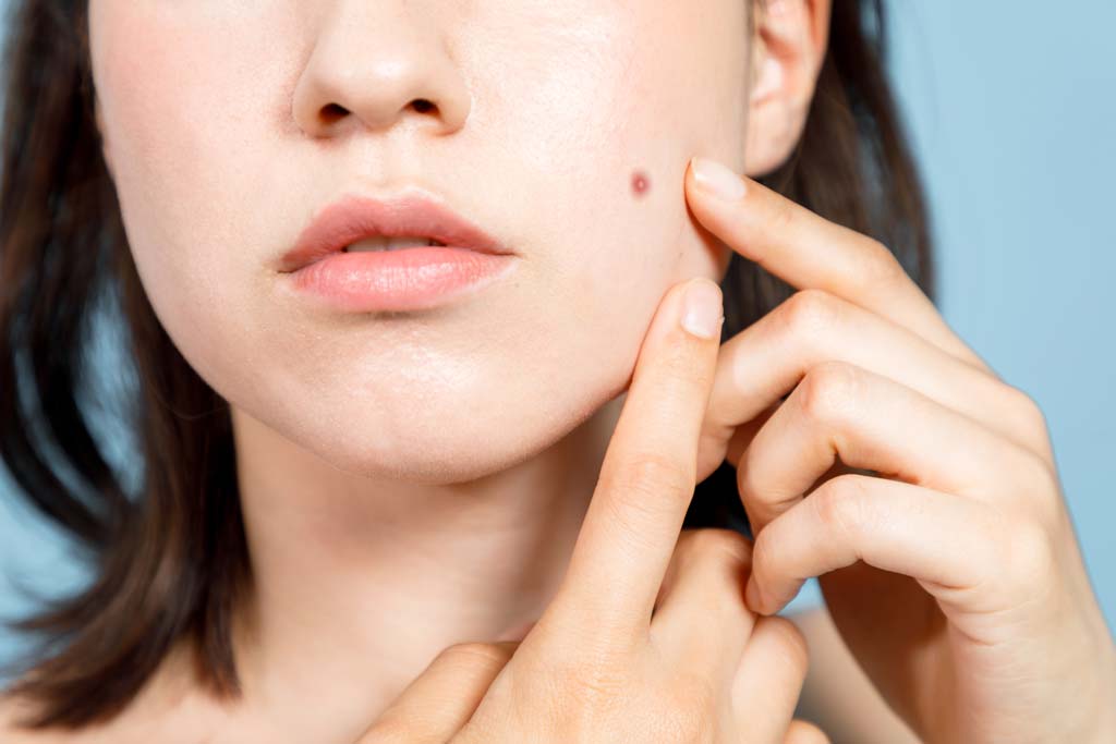 Tips-to-Use-Castor-Oil-to-Remove-Moles