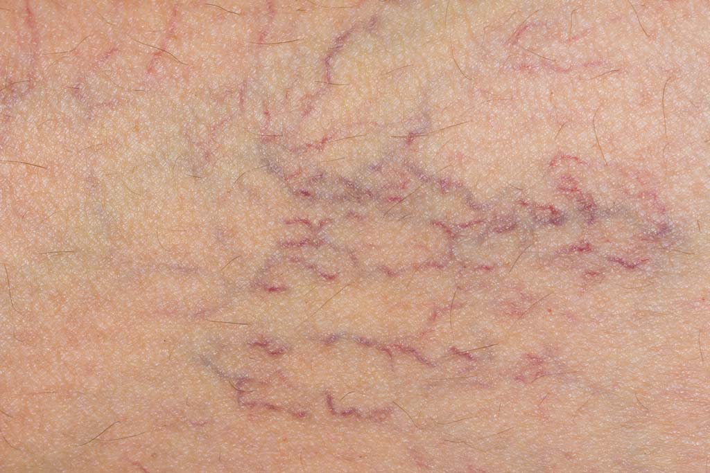 Varicose Veins - Causes, Home Remedies and Prevention