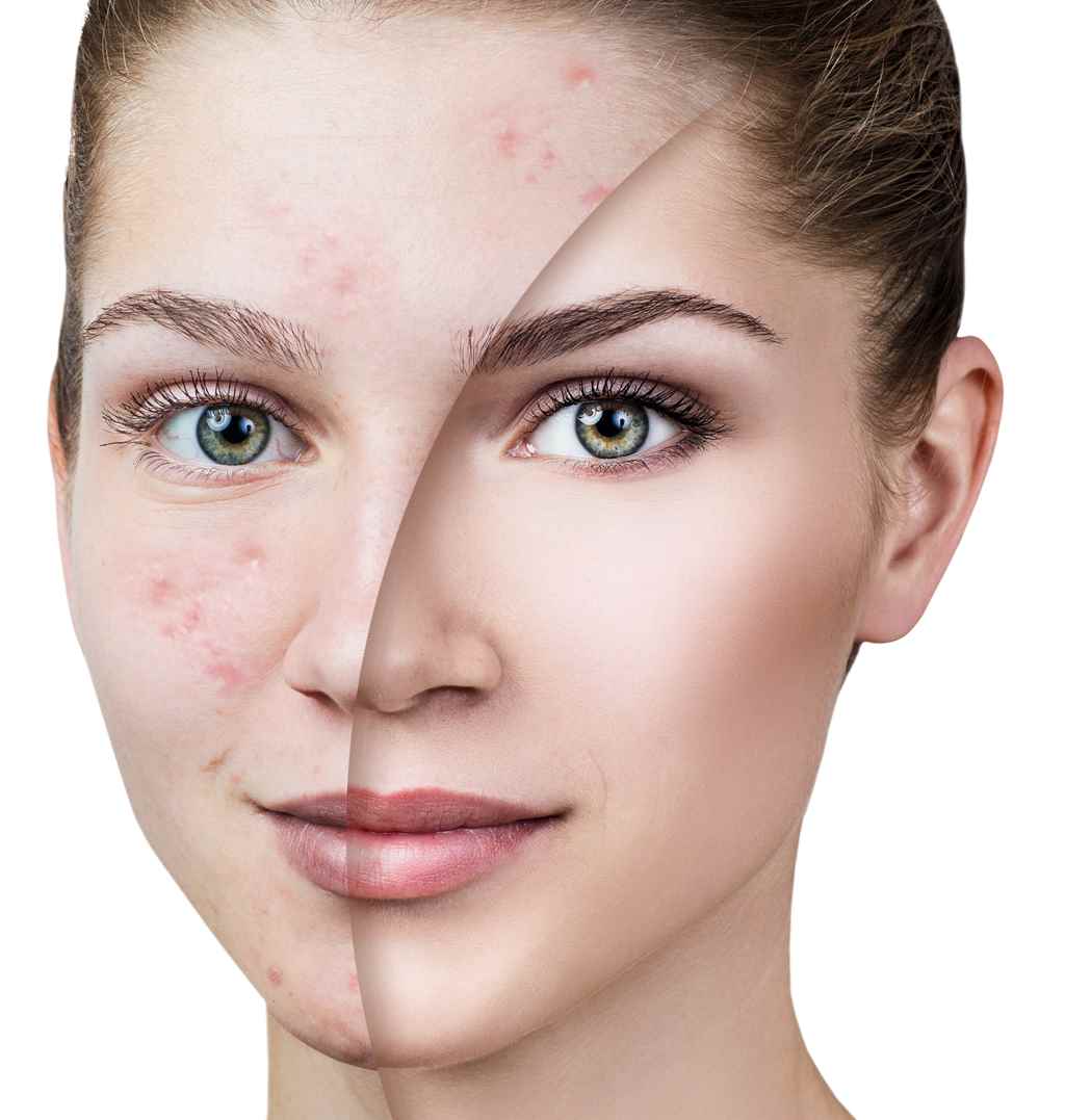 best-way-to-treat-acne