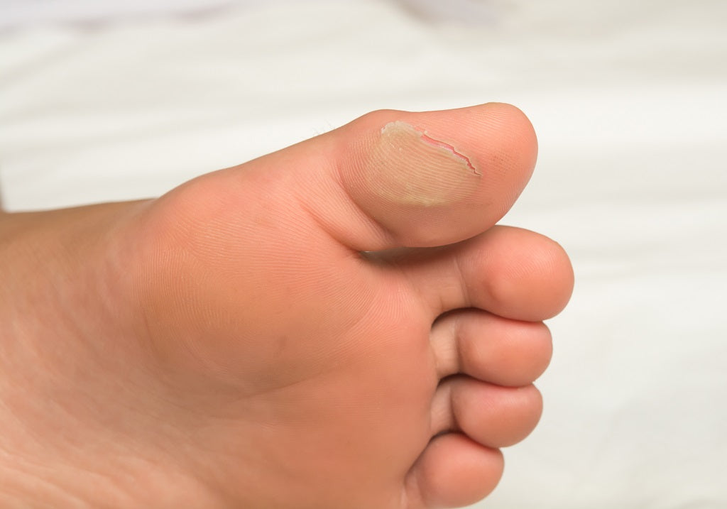 Blisters on Feet - Causes, Home Remedies and Prevention