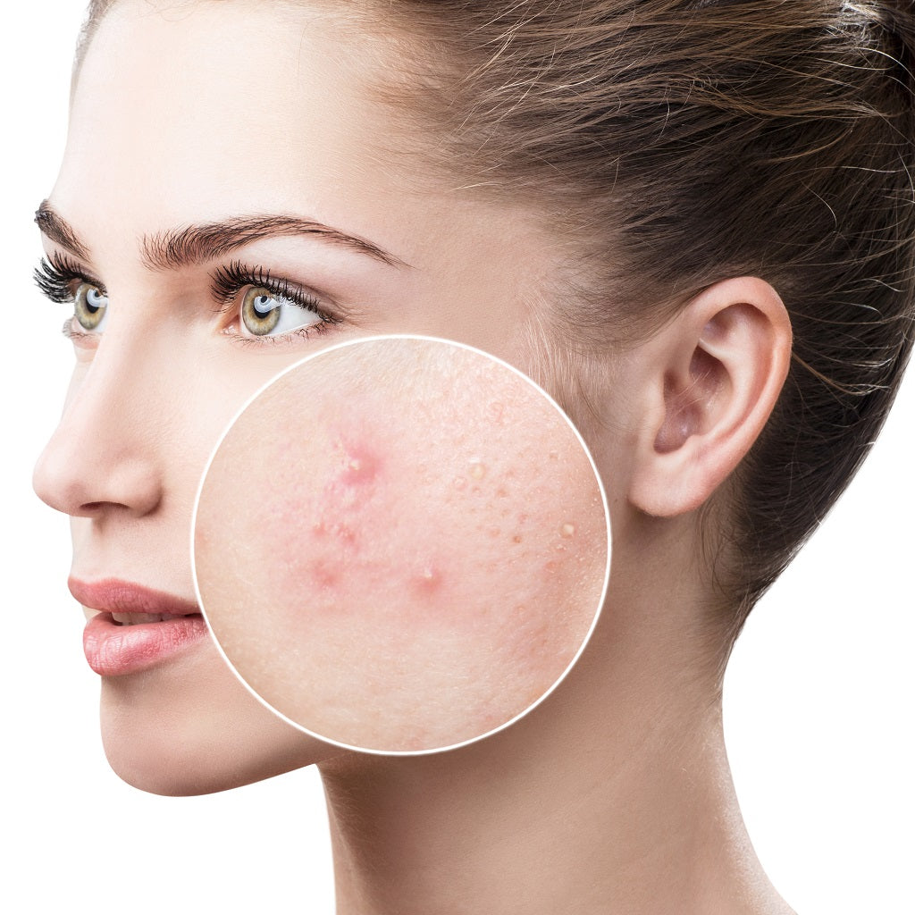 Foods to Include and Avoid in Your Diet to Fight Acne