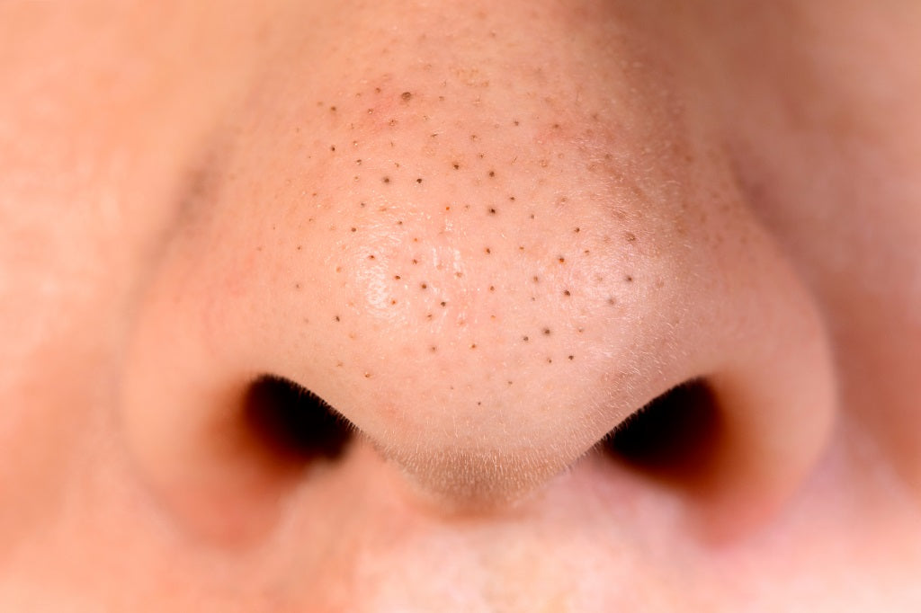 Top 25 Easy Home Remedies To Get Rid Of Blackheads