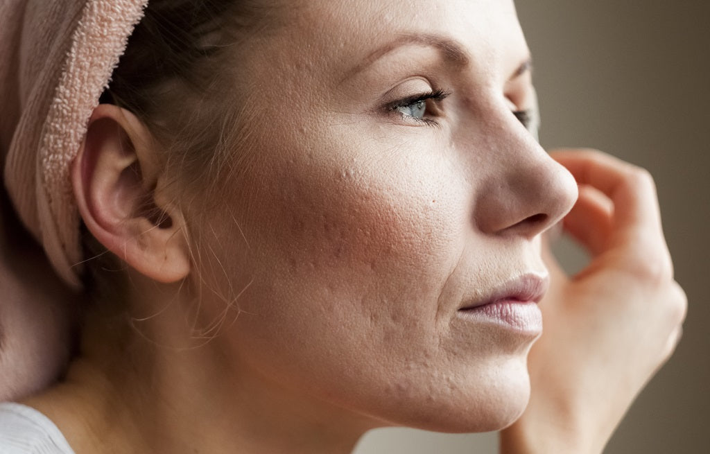 Perfect Guide to Know Everything About Acne
