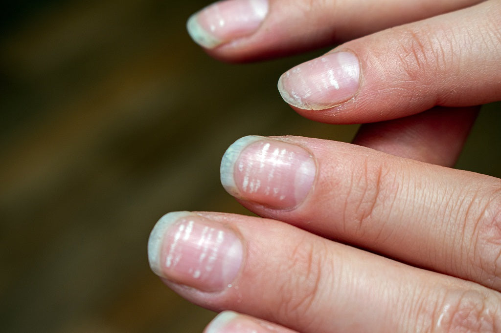 Signs Your Nails Give When You Are Vitamin Deficient
