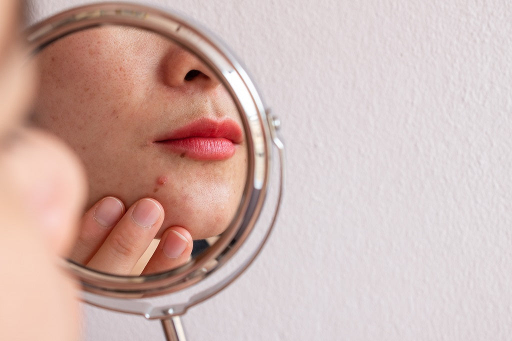 Why Scratching Your Acne / Pimples In Your 30s Is A Big No-No