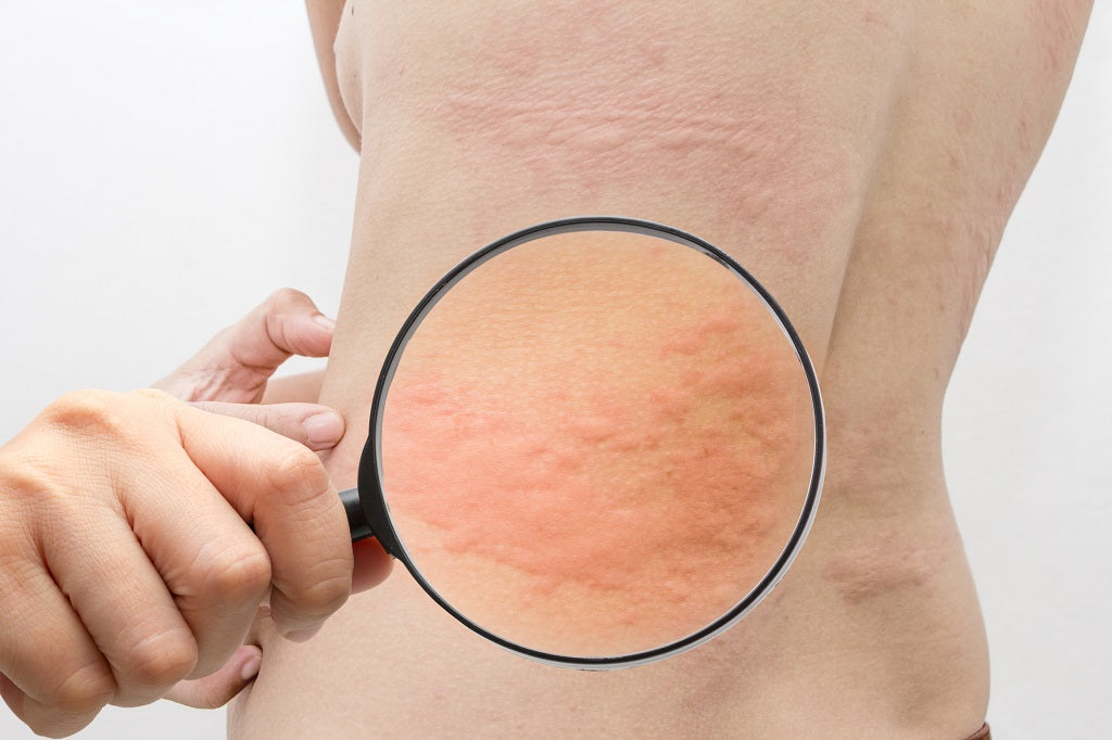 10 Best Home Remedies For Hives (Urticaria)