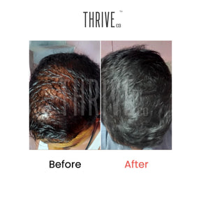 Hair Care Kit: ThriveCo Scalp Scrub (100ml) + Vitalizing Serum (50ml) + Hair Growth Serum (50ml)